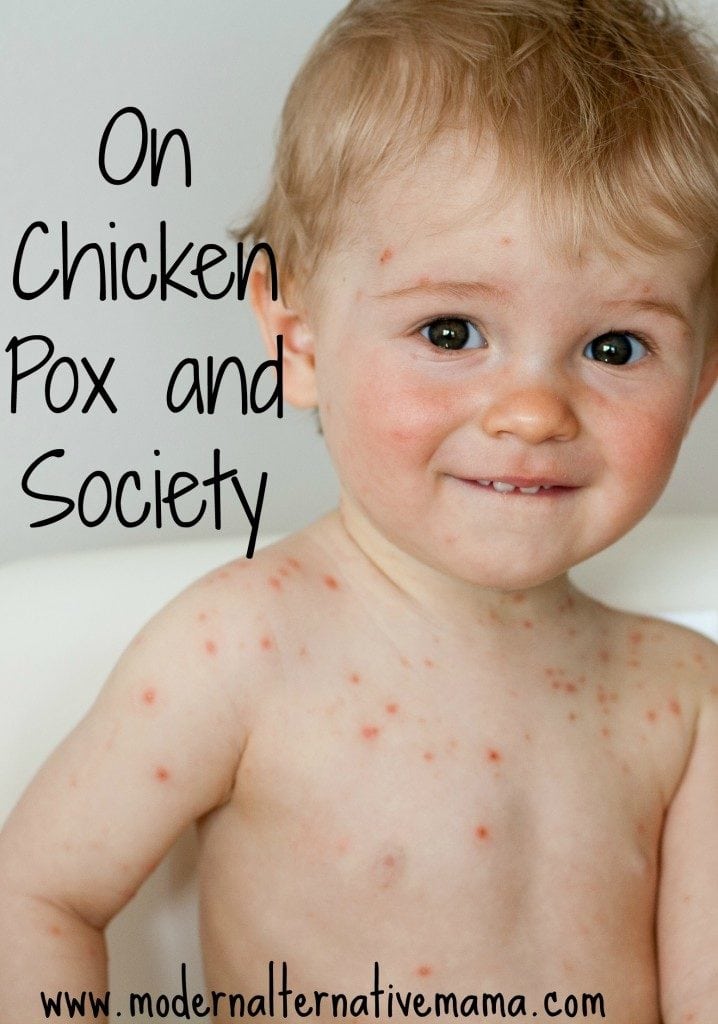 chicken pox and society pinterest