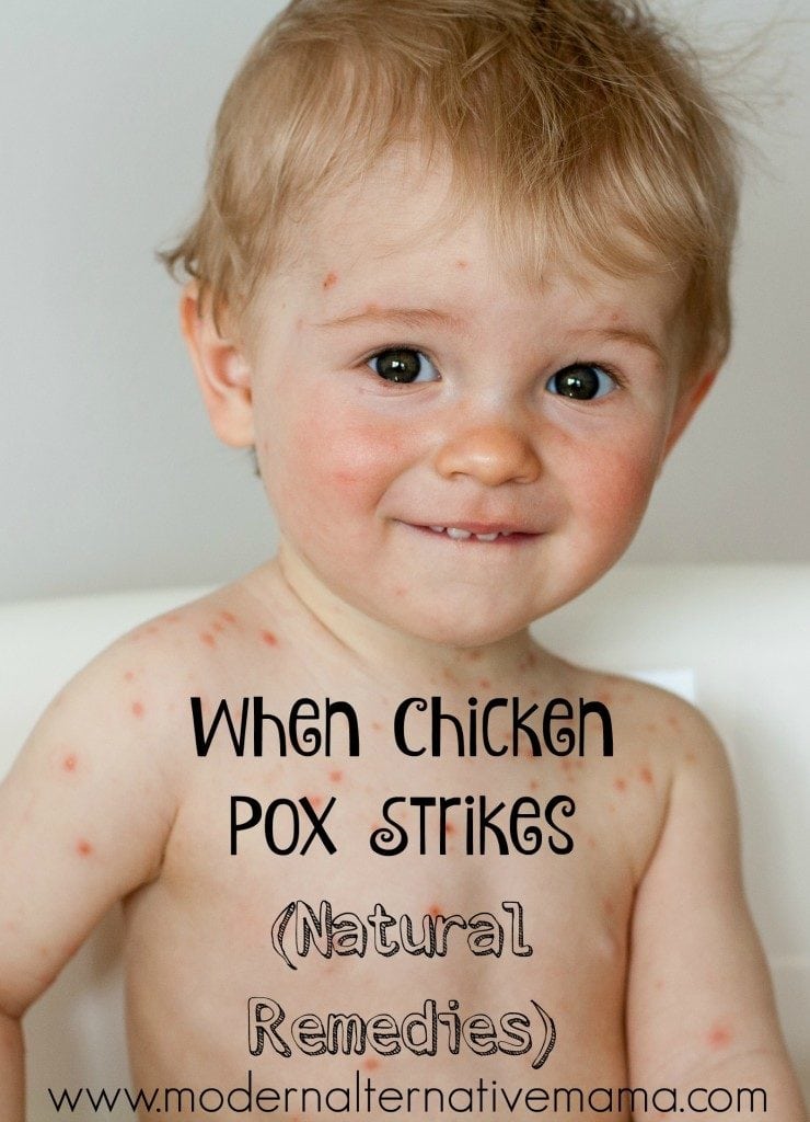 chicken pox strikes pinterest