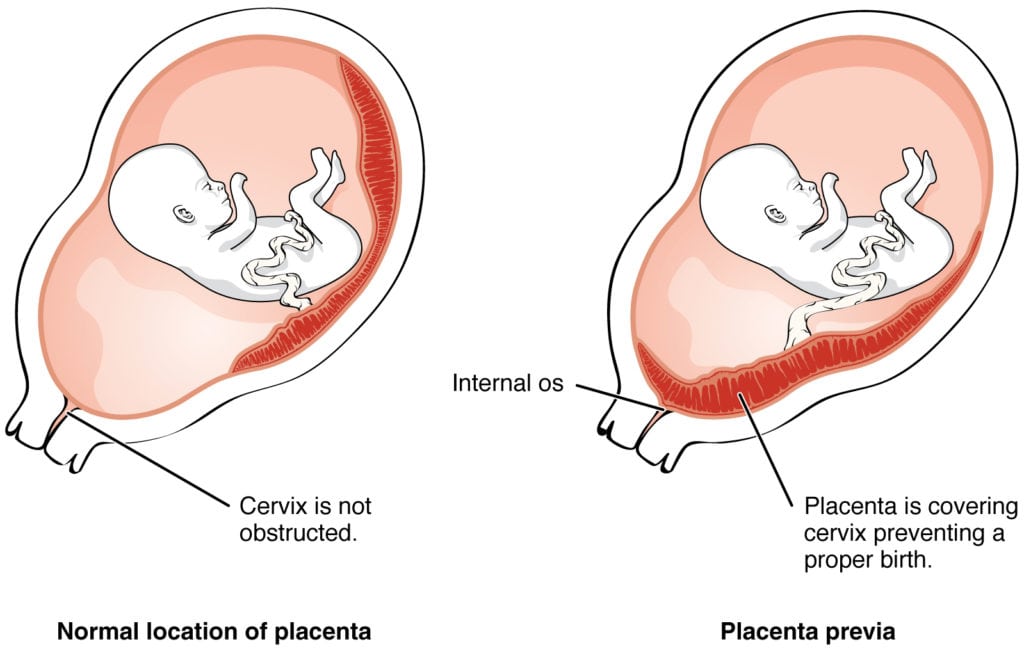 Placenta-Previa-Example - Modern Alternative Mama